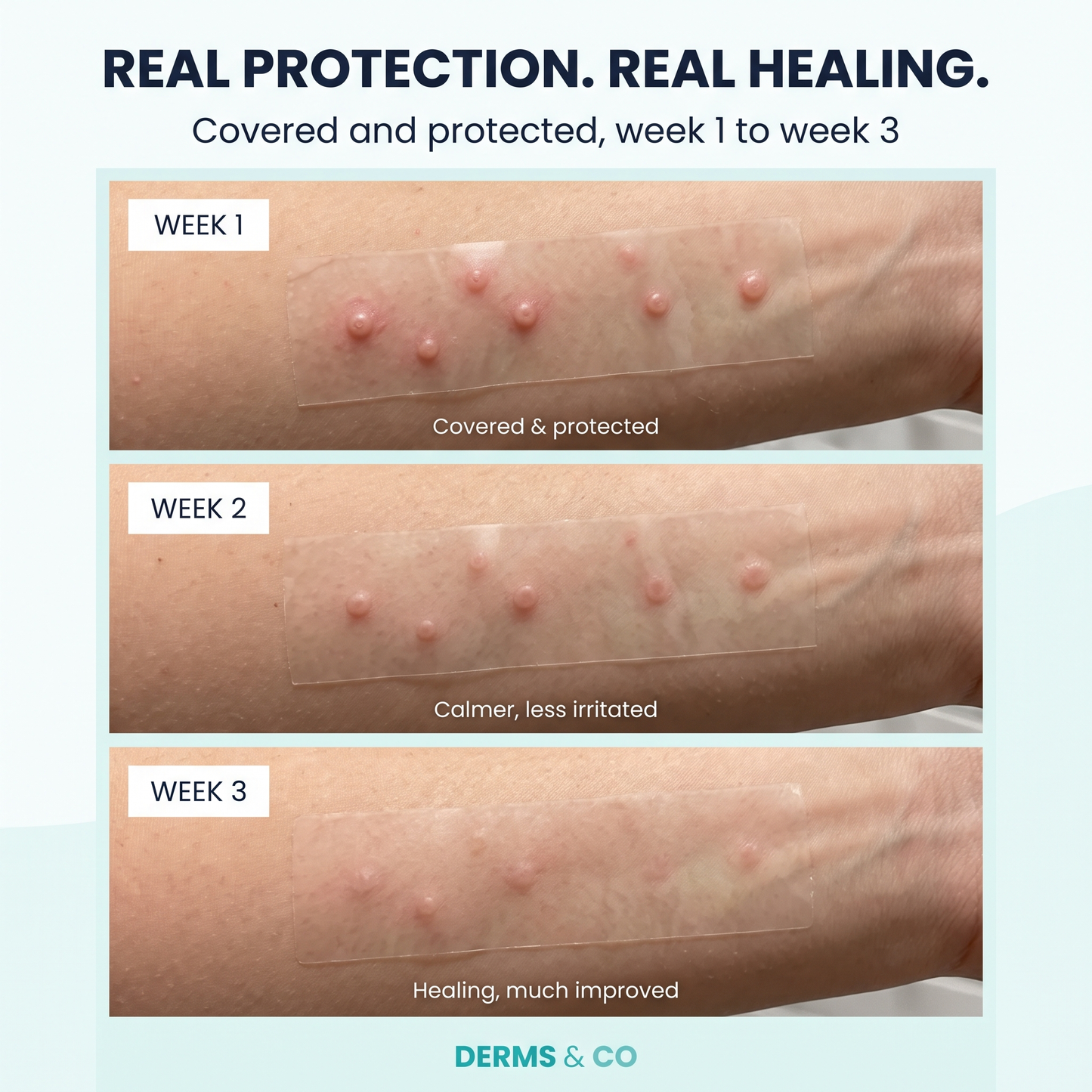 Derms & Co™ Hydrocolloid Roll For Molluscum