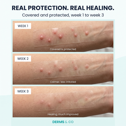 Derms & Co™ Hydrocolloid Roll For Molluscum